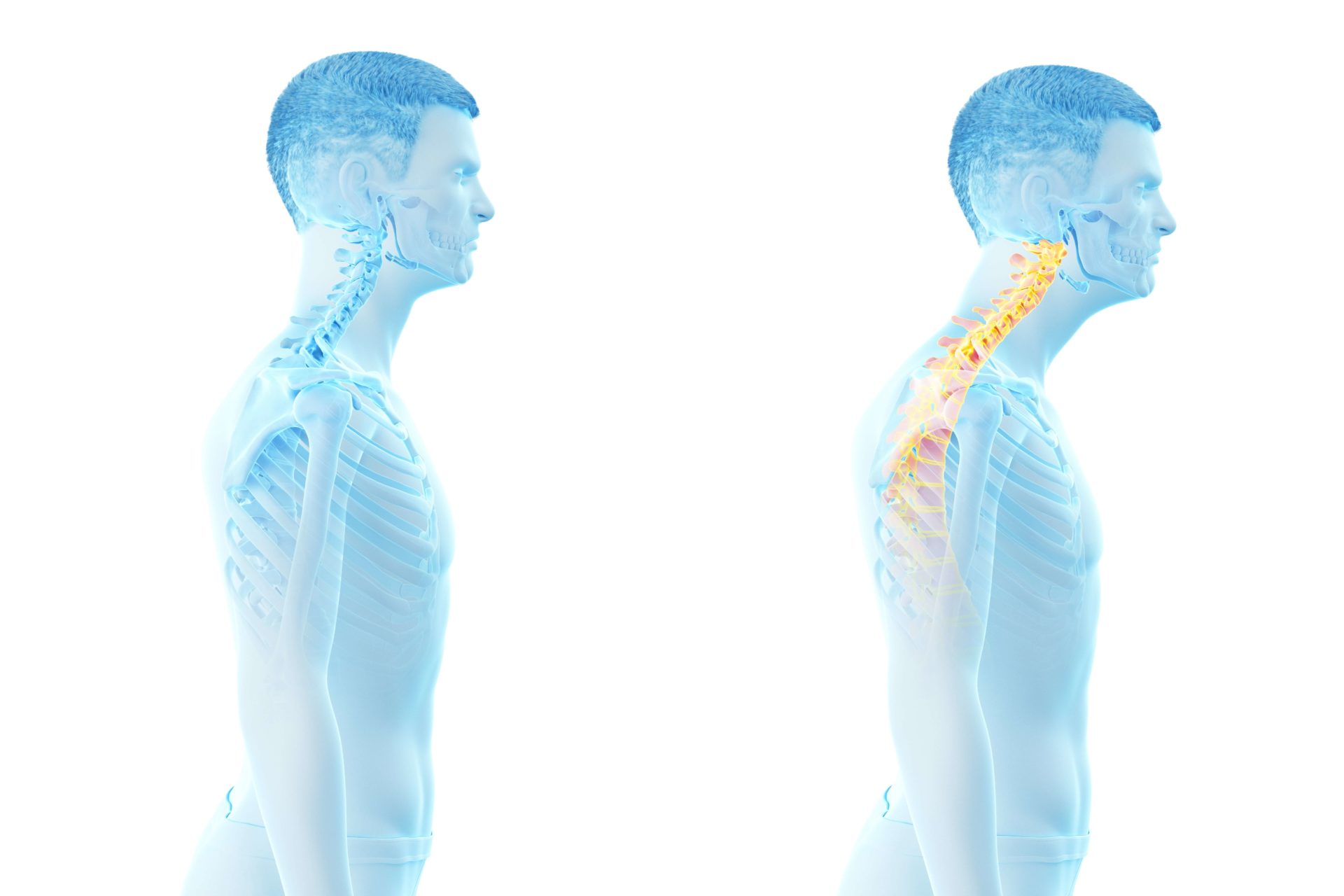 What is Forward Head Posture? - TMJ & Sleep Center